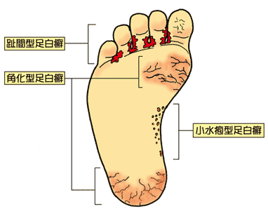 趾間型、小水疱型、角質増殖型の３タイプの水虫を紹介したイラスト