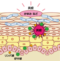 角質内部に侵食した白せん菌が定住し水虫に感染する様を示した図