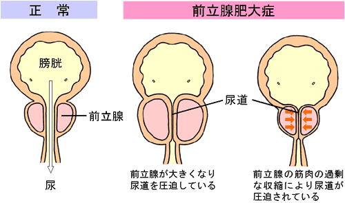 正常な膀胱と前立腺肥大症の膀胱の断面図